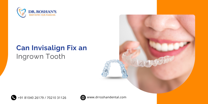 Can Invisalign Fix an Ingrown Tooth?