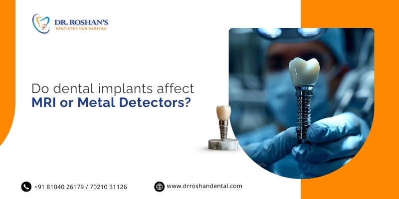 Do Dental Implants Affect MRI or Metal Detectors?