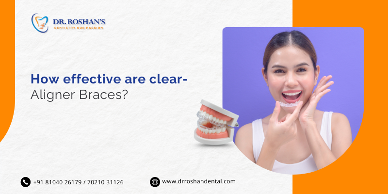How Effective Are Clear Aligner Braces?